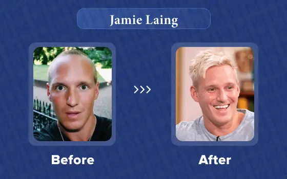 jamie laing hair transplant
