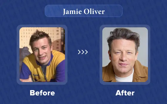 jamie oliver hair transplant