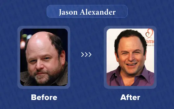 jason alexander hair transplant