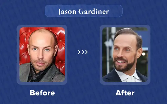 jason gardiner hair transplant