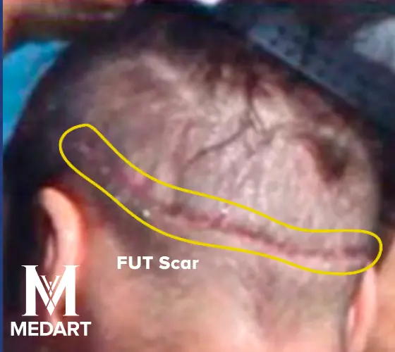 jeremy piven fut hair transplant scar
