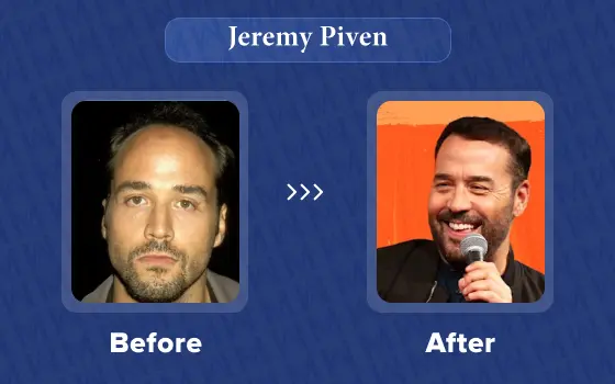 jeremy piven hair transplant