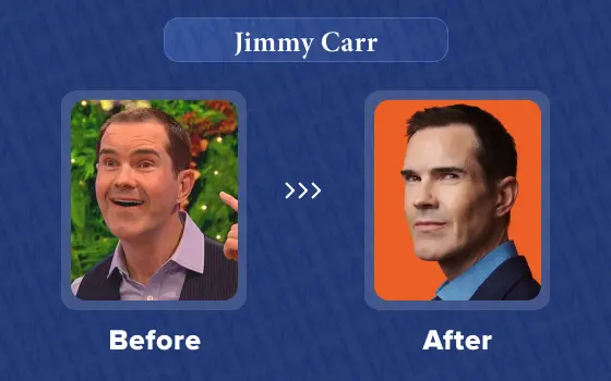 jimmy carr hair transplant