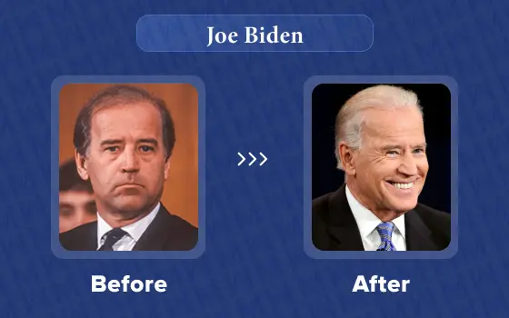 joe biden hair transplant