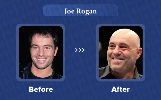 joe rogan hair transplant