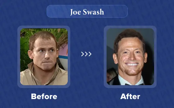 joe swash hair transplant