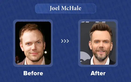 joel mchale hair transplant