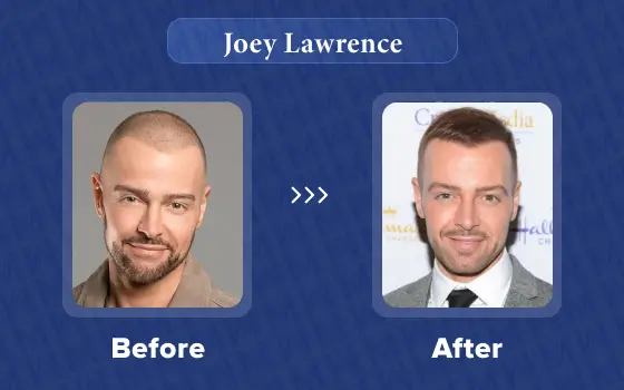 joey lawrence hair transplant
