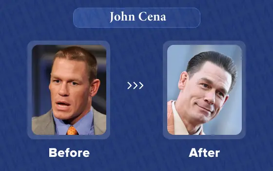 john cena hair transplant