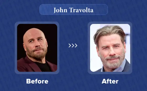 john travolta hair transplant