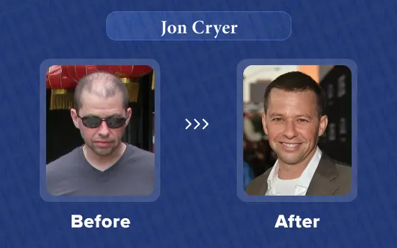 jon cryer hair transplant