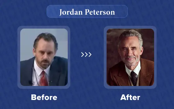 jordan peterson hair transplant