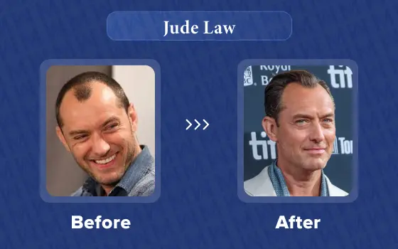 jude law hair transplant