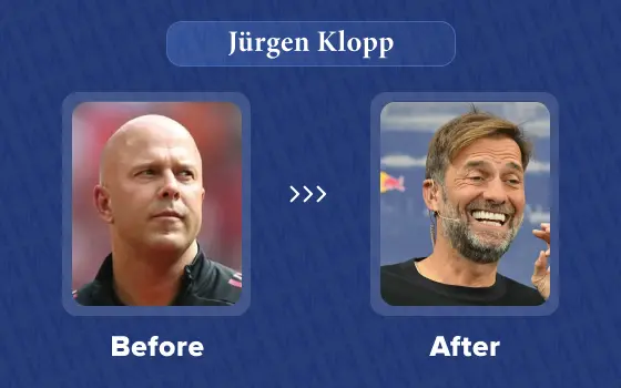 jürgen klopp hair transplant