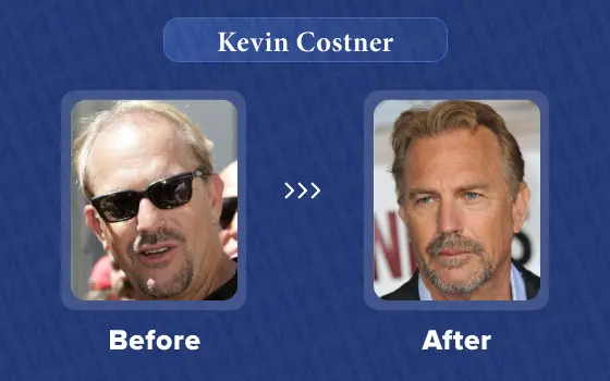 kevin costner hair transplant
