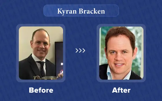 kyran bracken hair transplant