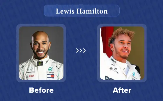 lewis hamilton hair transplant