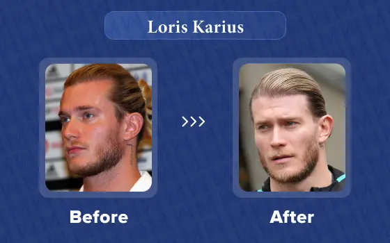 loris karius hair transplant