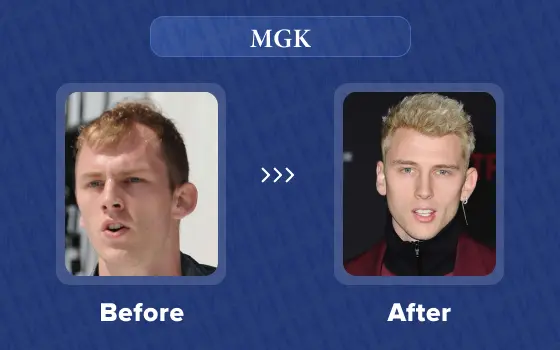 machine gun kelly hair transplant