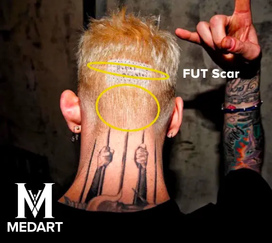 machine gun kelly fut hair transplant and fue hair transplant scars