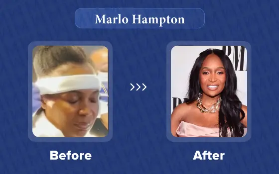 marlo hampton hair transplant