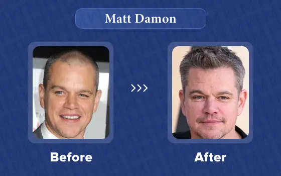 matt damon hair transplant