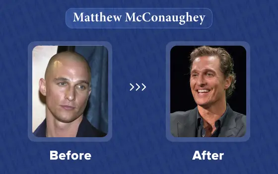 Matthew McConaughey hair transplant