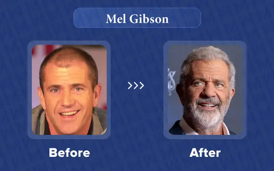 mel gibson hair transplant