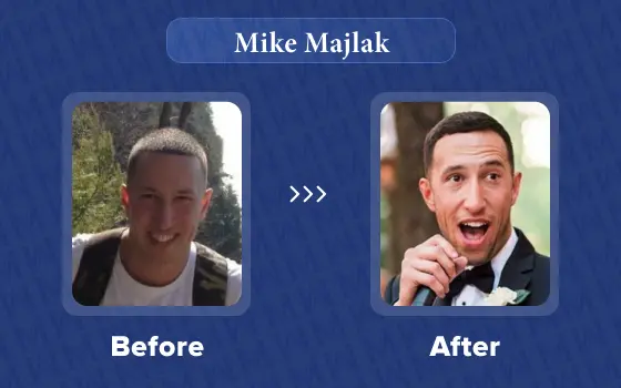 mike majlak hair transplant