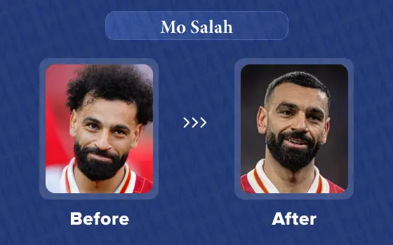 mo salah hair transplant
