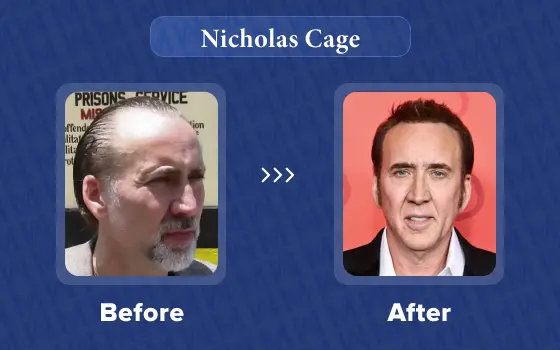 nicolas cage hair transplant