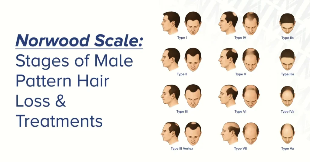 Featured image with article title "Norwood Scale: Stages of Male Pattern Hair Loss & Treatments" on the left and visual stages of 12 Norwood air loss patterns on the right