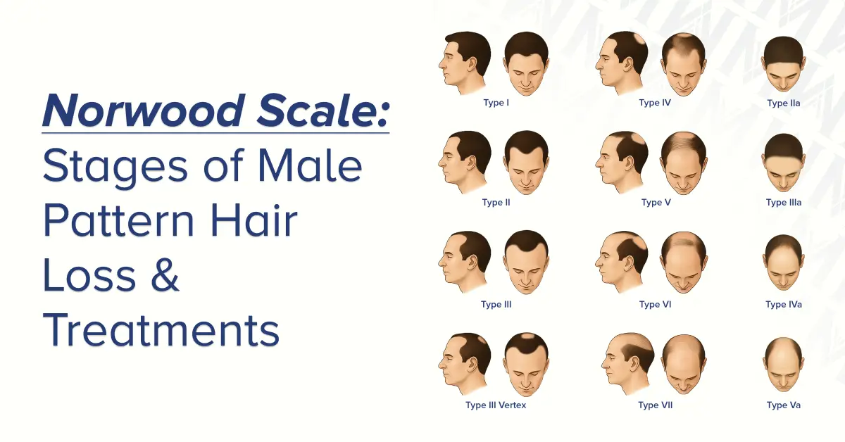 Featured image with article title "Norwood Scale: Stages of Male Pattern Hair Loss & Treatments" on the left and visual stages of 12 Norwood air loss patterns on the right