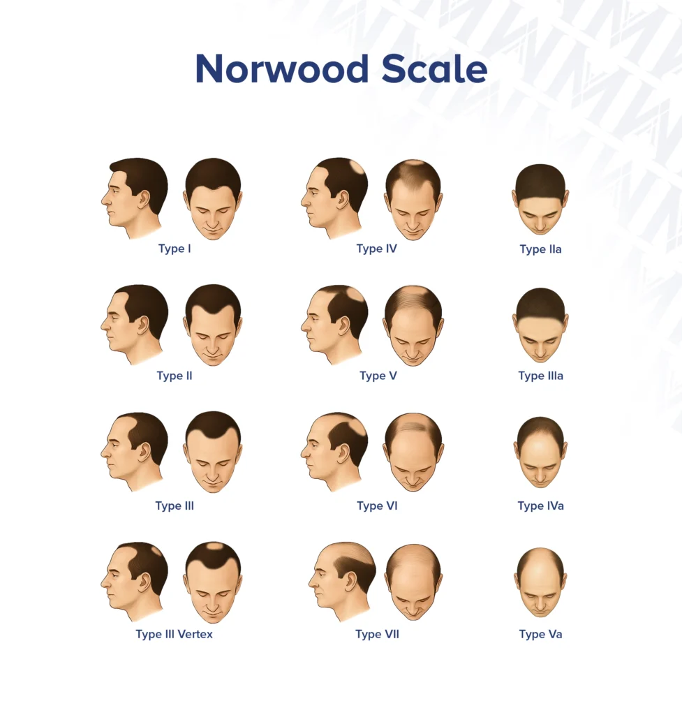 Infographic showing 12 distinct types of hair loss on the Norwood scale from side profile view and front view