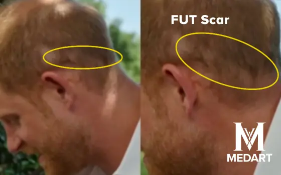 prince harry fut hair transplant scar