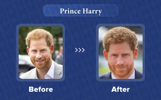 prince harry hair transplant