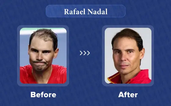 rafael nadal hair transplant