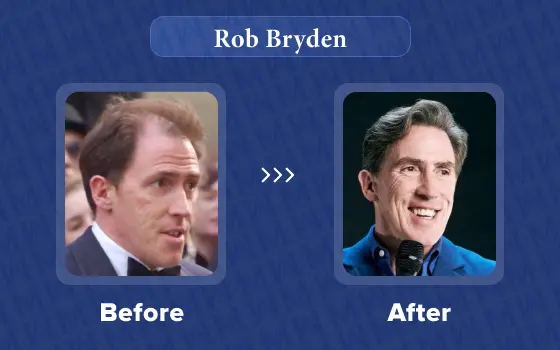 rob brydon hair transplant