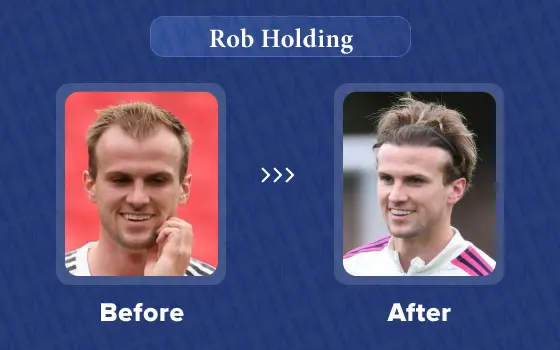rob holding hair transplant