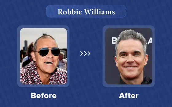 robbie williams hair transplant