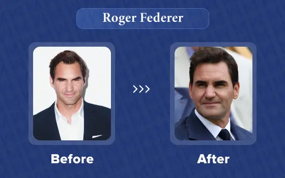 roger federer hair transplant