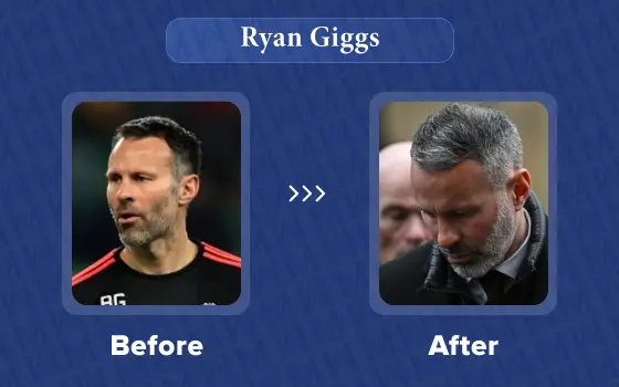 ryan giggs hair transplant