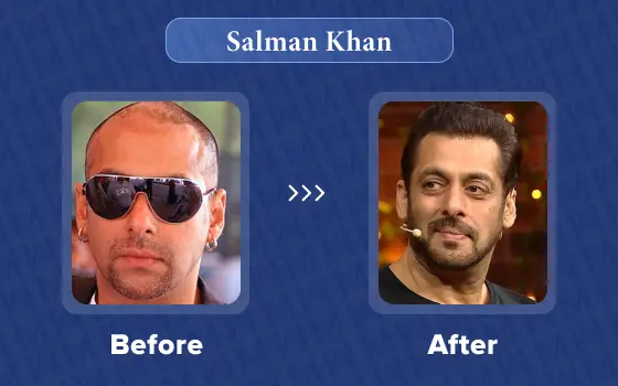 salman khan hair transplant