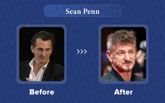 sean penn hair transplant