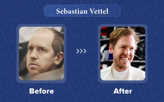 sebastian vettel hair transplant