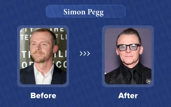 simon pegg hair transplant