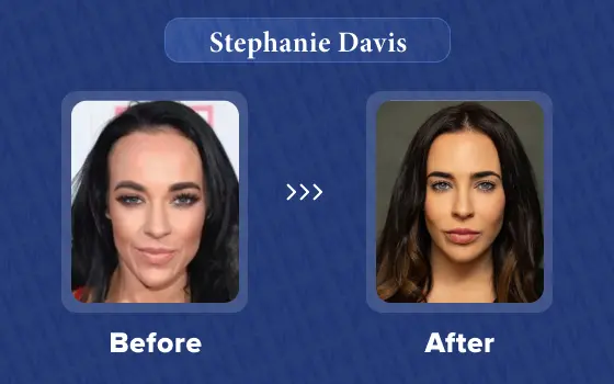 stephanie davis hair transplant
