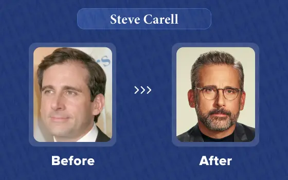 steve carell hair transplant