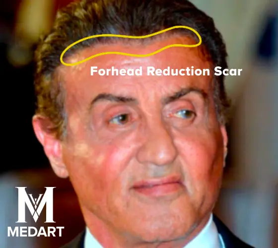 sylvester stallone forhead reduction scar