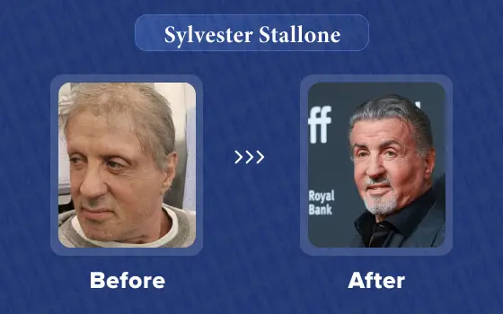 sylvester stallone hair transplant